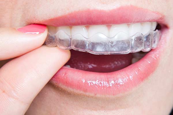 Clear-Aligners